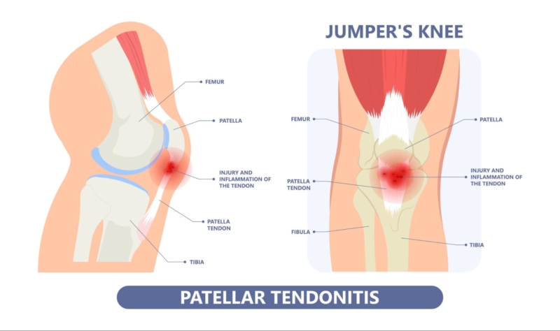 jumpers knee (patellar tendonitis)