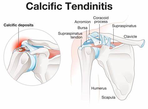 Calcific tendonitis